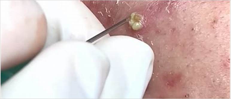 Videos of pimple extractions
